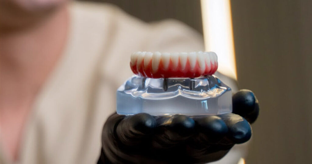 Implante Dentário em Até 3 Dias: É Possível?