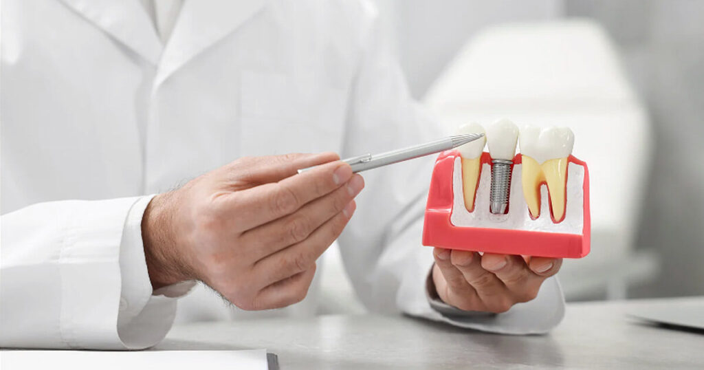 O Que Fazer Quando Implante Dentário Fica Mole? Pode Acontecer?