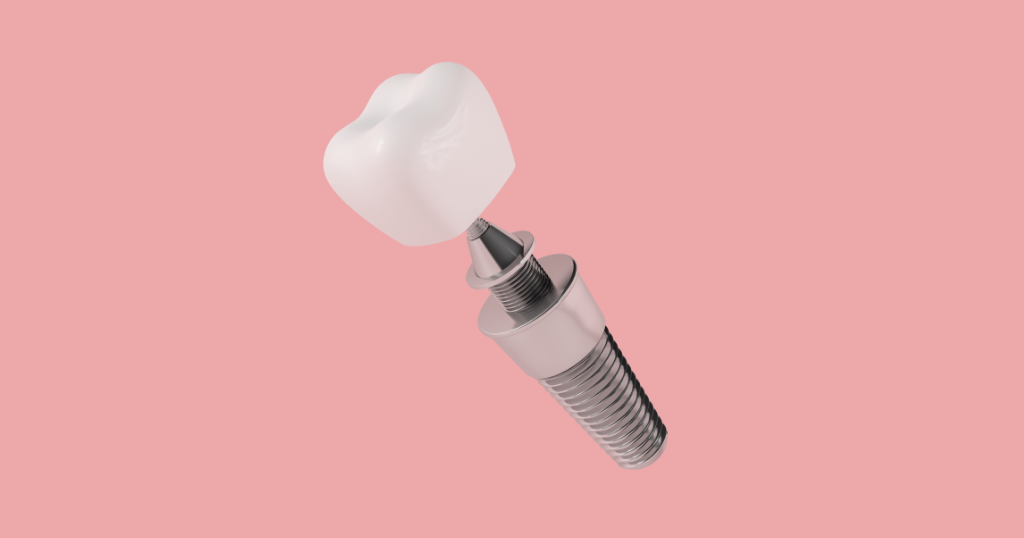 como é feito implante dentário natal rn